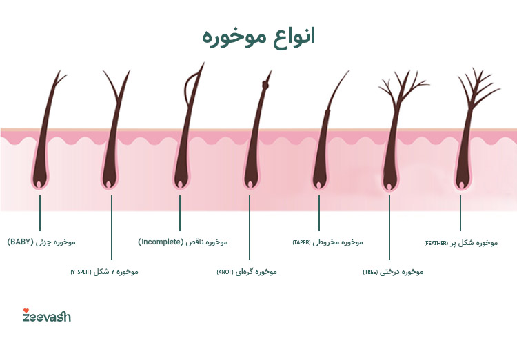 انواع موخوره شامل موخوره Y شکل، شکل پر، حالت درختی، مخروطی شکل و گره‌ای هستند.